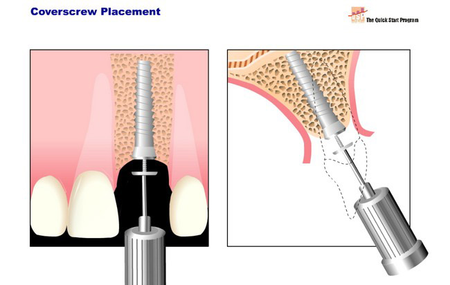 Implant Flash Animation